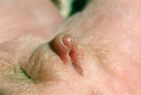 Micropenis-cleft-scrotum-ne.jpg
